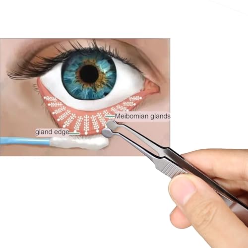 Premium Stainless Steel Arita Tauber Meibomian Gland Expressor Forceps Eyelid Massage Tweezers-Round Tip..