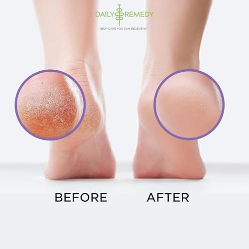 Daily Remedy Calming Lavender Foot Soak 16 oz – Epsom Salt Foot Bath for Tired Feet, Odor & Calluses