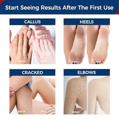 OUKEYA Urea Cream 42 Percent with 2% Salicylic Acid Tube 3 Oz,Urea Foot & Hand Cream for Dry Cracked,40 per Lotion for Feet Maximum Strength