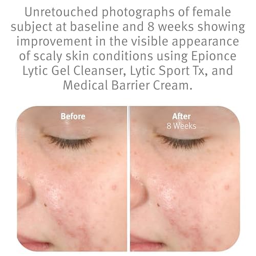 Epionce Lytic Gel Cleanser ? Gentle Foaming Face Wash & Makeup Remover | For Oily, Combination & Problem Skin | Acne & Oil-Control Cleanser with Willow Bark | Dermatologist Skincare