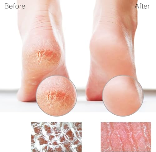 Sunivaca Nano Glass Foot File - Professional Callus Remover for Feet