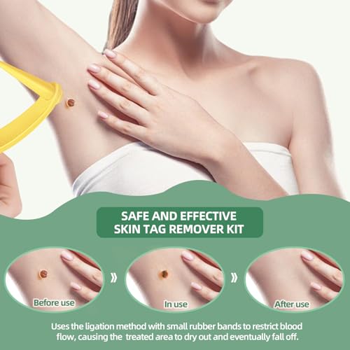 Dual-Size Skin Tag Removal Kit – At-Home Ligation System