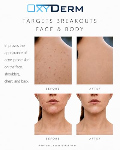 OxyDerm Acne Spot Treatment - Fast-Acting Invisible Formula