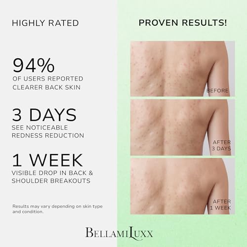 BellamiLuxx Back Acne Spray with 2% Salicylic Acid