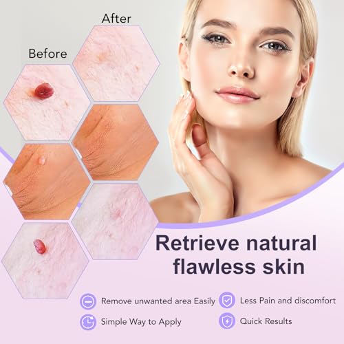 AL-40 Skin Tag & Wart Removal Kit – Professional Home Treatment