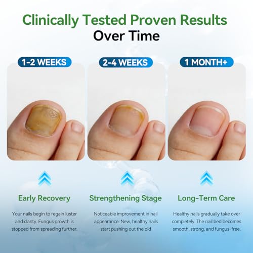 Maximum Strength Toenail Fungus Treatment Pen - 25% Undecylenic Acid, 4 Pens with Nail Files