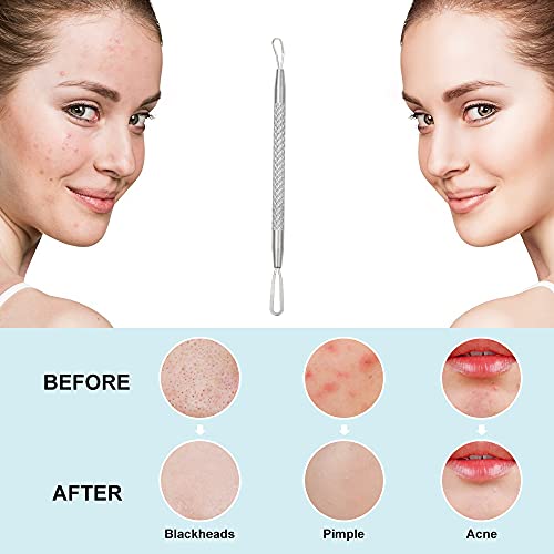 La Chat Blackhead Remover - 2-in-1 Pimple Extractor Tool