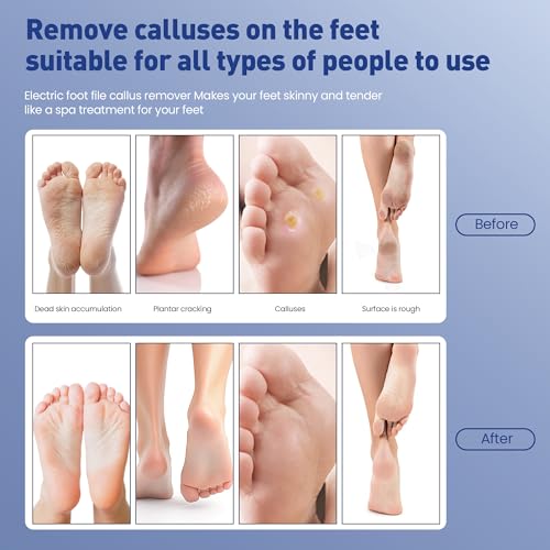 MUXUN Black Mini Rechargeable Electric Foot Callus Remover 9-Speed Pedicure Tool
