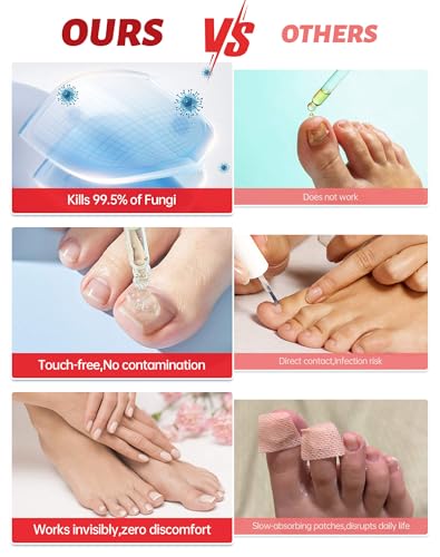 Extra Strength Toenail Fungus Treatment - 25% Undecylenic Acid