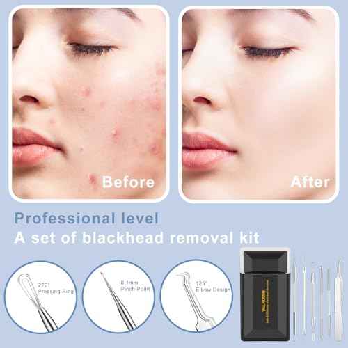 Pimple Extractor Tools, 6-PCS Professional Stainless Steel Blackheads, Whiteheads, Pimples, Boils, Stray Hairs Remover Tools Set with Mirror and Product User Manual, 18-Month Replacement Warranty£¡