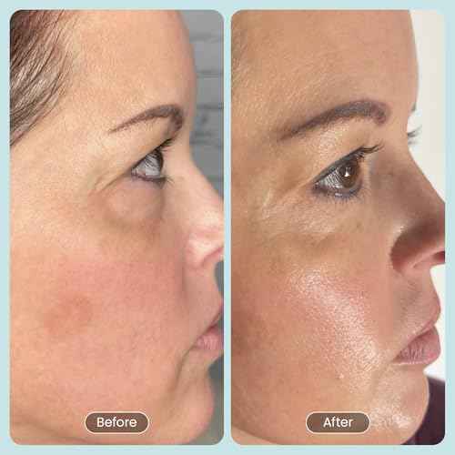 30 DAY MIRACLE BHA 20% Peeling Solution - Clinical Strength BHA Liquid Exfoliant for Clogged Pores, Wrinkles & Blackhead Remover - Salicylic Acid Serum & Chemical Exfoliant for Face Peel 1oz