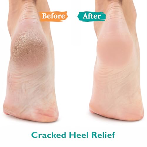 Gilden Tree 42% Urea Foot Gel - Maximum Strength Cracked Heel Care