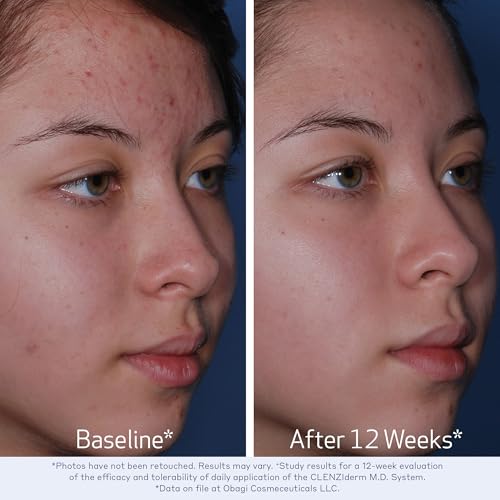 Obagi CLENZIderm M.D. Pore Therapy Exfoliating BHA Toner - Unclogs Pores with 2% Salicylic Acid Acne Treatment ? 5 oz