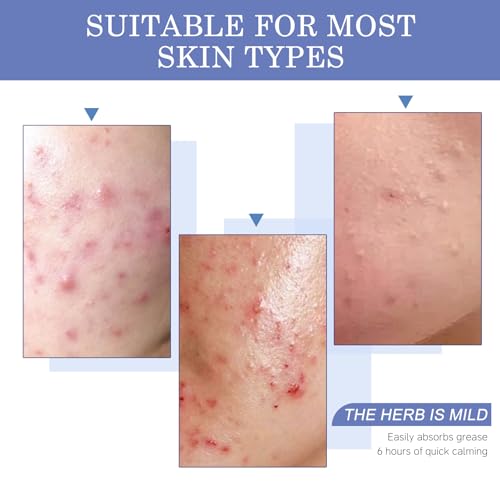 Acne Pimple Patches - 4 Sizes, 220 Count, Hydrocolloid Formula