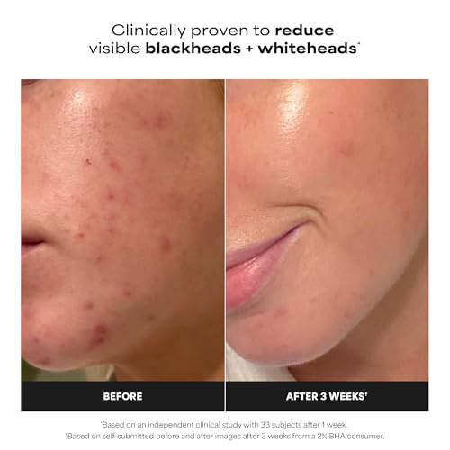 Paula's Choice 2% BHA Liquid Exfoliant for Face, 5 Fl Oz - Gentle Pore Clarifying Treatment