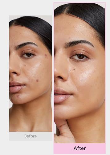 EasyDerm 4-Type Acne Patches Variety Set + Pimple Popper Tool