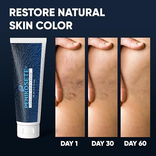 PENIKOSETE Varicose & Spider Vein Cream - Natural Ayurvedic Leg Formula