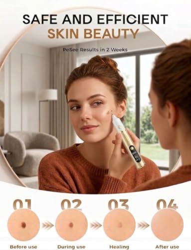 Skin Tag Remover Pen - 19 Intensity Levels & LED Light