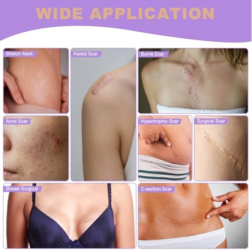 WZPB Silicone Scar Sheets for Scar Removal - Medical Grade Scar Tape for Surgical Scars, C-Section, Keloid, Hypertrophic & Acne Scars | 1.5" x 120" Reusable & Waterproof Scar Strips Roll (2 Pack)