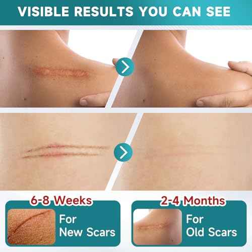 Silicone Scar Sheets, Silicone Scar Tape(5.7¡± x 1.57¡± 10 Pcs), Scar Removal Away Strips for Surgical Scars, Keloid, C-Section, Burn et