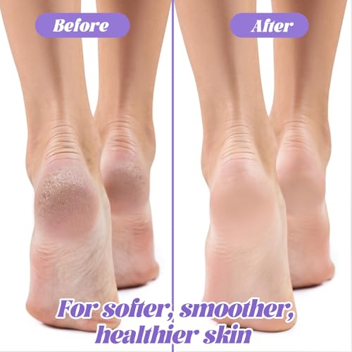 Grevosea Double-Sided Foot Pumice Stones 5-Pack for Callus & Dead Skin Removal