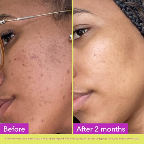 Good Molecules 10% Azelaic Acid Face Treatment - 30ml