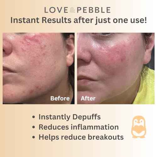 Love & Pebble Beauty Pops - Ice Roller Massage & Skin Care Ice Mask for Face Set with Turmeric & Aloe | Cryo Dermal Benefits of Ice Face Roller and Gua Sha, As Seen on Shark Tank and Tik Tok