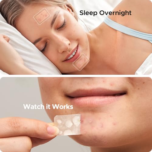 Large Pimple Patches for Face, 7 Sizes Big Acne Patches, FSA Eligible XL Hydrocolloid Bandages for Body, Chin, Forehead, Nose, Blemish Zit Breakouts, Hydrocolloid Patch (Square, Strip, Dot 142 Count)