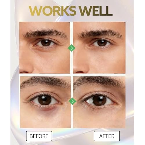 Eye Bags Treatment for Men and Women, Caffeine Eye Cream with Roller for Dark Circles & Puffiness, Anti Aging Formula with Hyaluronic Acid, Retinol & Niacinamide to Reduce Wrinkles and Fine Lines