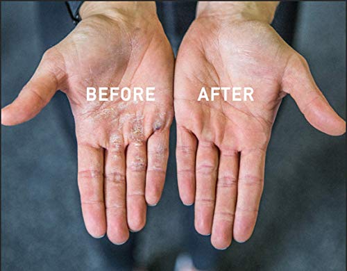 Hand Callus Remover Tool | Removes Calluses in Seconds | No Pumice Needed