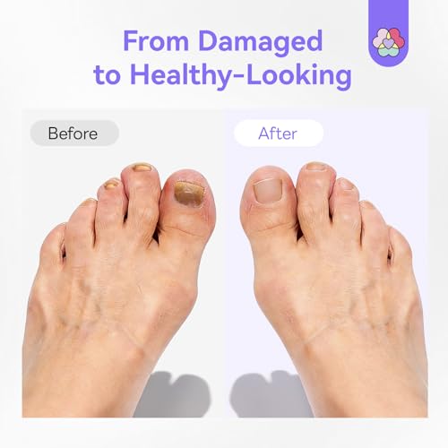 SAVILAND Toenail Fungus Pen Treatment 3-Pack with 25% Undecylenic Acid & 1% Tolnaftate