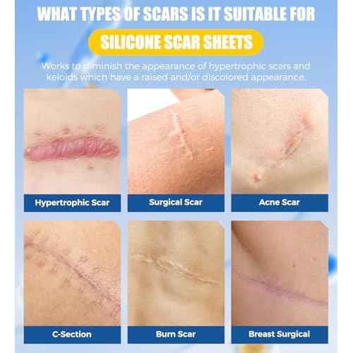 Medical Grade Silicone Scar Sheets & Tape - 1.6¡±x60" Roll, Ultra Soft, Hypoallergenic Rolls for Surgical, Keloid Scars, Tummy Tuck, C-Section, Stretch Marks, Burn & Bumps Scar Removal, 24H Comfortable
