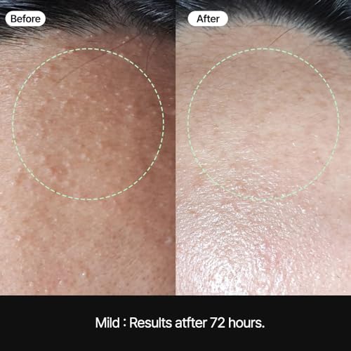 Comedones Patch 50 Sheets - Gentle Sebum Removal