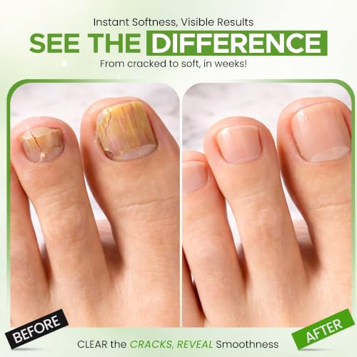 CLEAR 40% Urea Nail Gel with Tea Tree Oil – Night Time