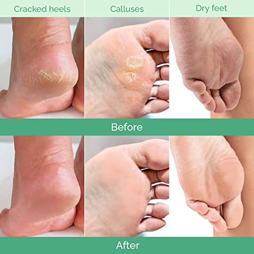 PLANTIFIQUE Foot Peeling Mask 2 Pack | Dermatologist Tested