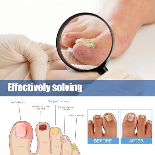 Extra Strength Toenail Fungus Treatment Patches - 60 Pcs Hydrogel