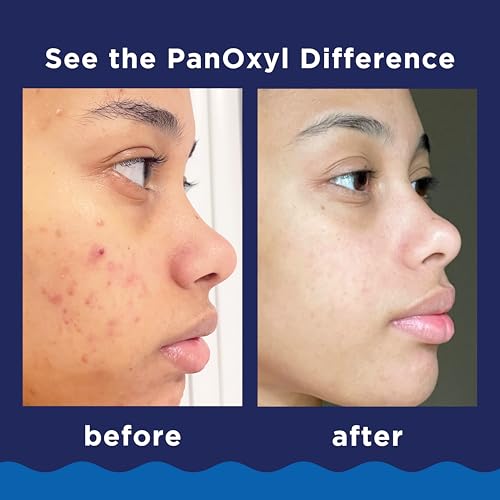 PanOxyl Acne Foaming Wash Benzoyl Peroxide 10% Maximum Strength Antimicrobial, 3 Oz, Pack of 2