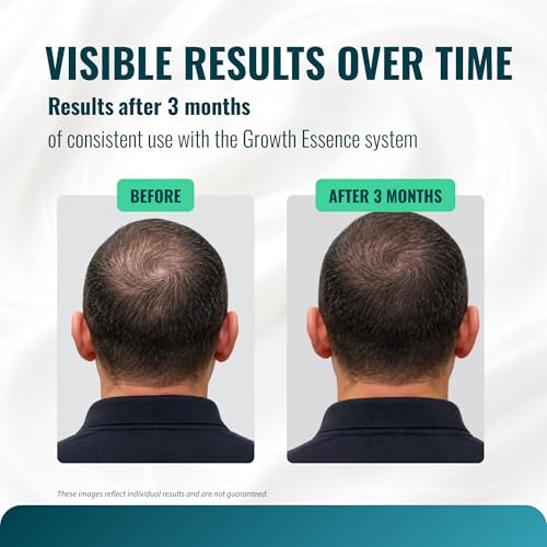Minoxidil 5% Cream with Biotin & Caffeine for Hairline & Beard