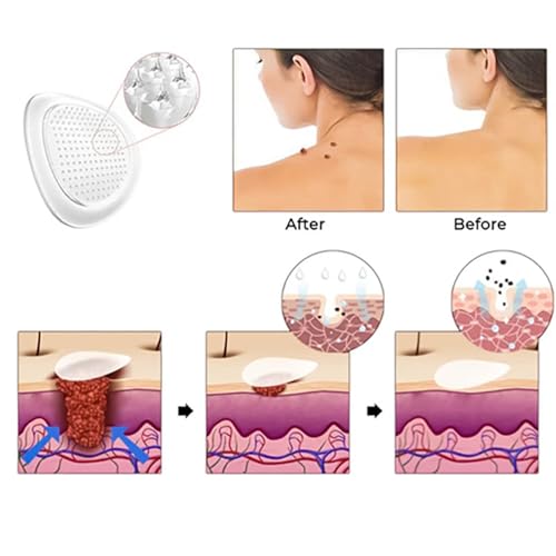 Hydrocolloid Acne Patch with Salicylic Acid, 144 Count