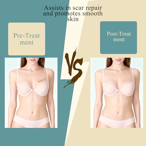 Scar Away Silicone Scar Sheets for Breast - 8 Pack (4 Areola + 4 Anchor) - Reusable for C-Section, Breast & Surgical Scars and Keloid Scars