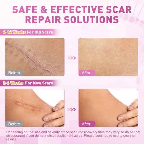 Silicone Scar Sheets & Tape (1.6" x 120"-3M) - Reusable Soft Medical Grade Silicone Strips Patches for Surgical, Keloid, Acne, Burn, C - Section, Facial & Face Skin Scars