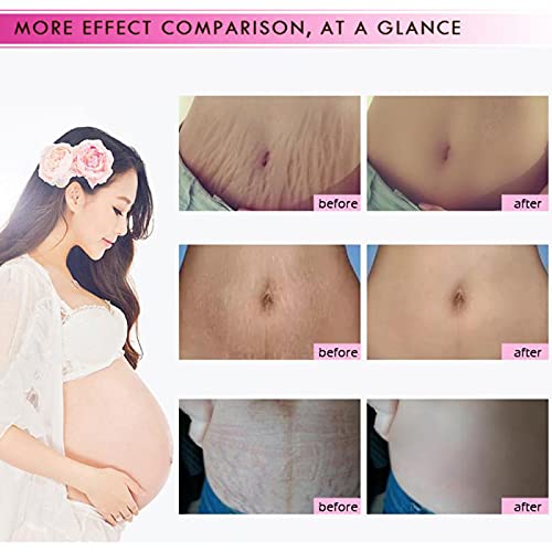 Mango Stretch Mark & Scar Removal Cream 40g