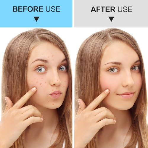 Pimple Popper Tool Kit - 9-Function Blackhead Remover (5 Piece)