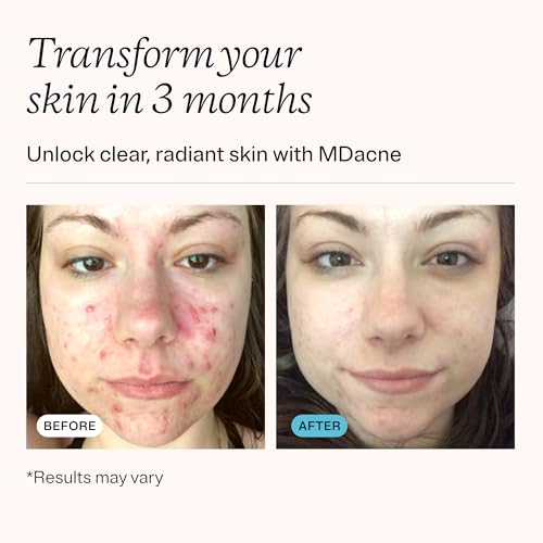 MDacne 5% Benzoyl Peroxide Acne Treatment Cream for Clear Skin