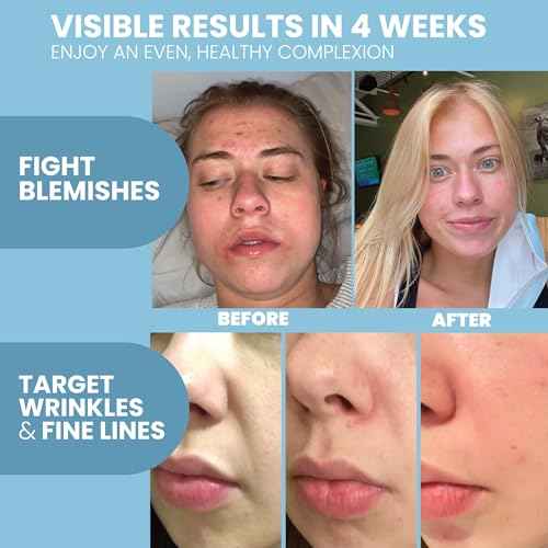 Retinol Serum for Face with Hyaluronic Acid & Vitamin E - For Anti-Aging, Fine Lines, Wrinkles, Resurfacing, Acne Marks and Scars, Skin Brightening, Dark Spot Correction Night Serum - 1oz