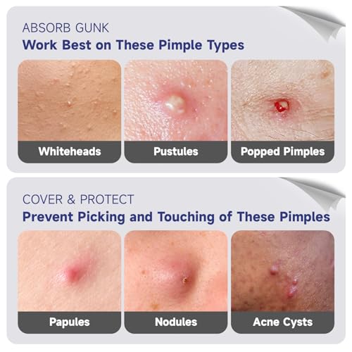 Cute Pink Heart Pimple Patch with Salicylic Acid, Hydrocolloid Pimple Stickers Iridescent Colors 48 Pcs, Fashion Zits Blemishes Breakouts Patches