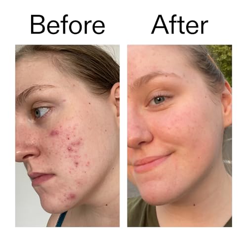 The INKEY List 10% Glycolic Acid Toner for Oily Skin, Brightening & Exfoliating, 3.4 fl oz