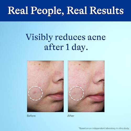 Differin Acne Spot Treatment with 10% Benzoyl Peroxide, Maximum Strength OTC Acne Treatment, Fast Acting Spot Treatment for Face, 1 oz