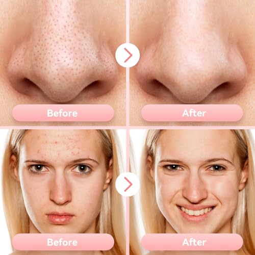 Blackhead Remover Pore Vacuum with 5 Suction Levels