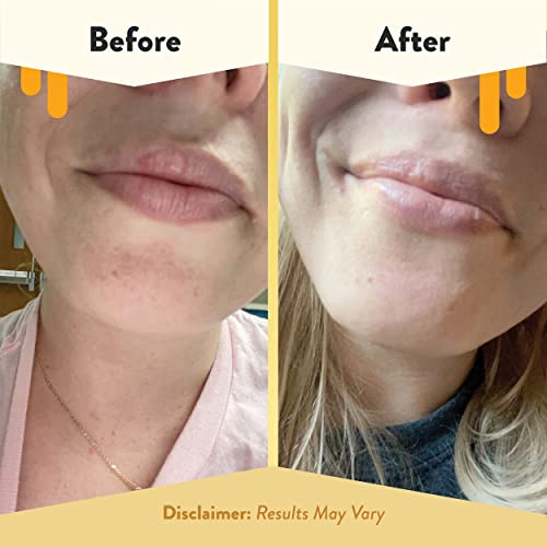 ECZEMA HONEY Nourishing Lip Balm - Organic Chapstick for Sensitive Skin - Daily Lip Moisturizer for Very Dry Lips - Mango Butter & Honey Lip Balm - Natural Lip Care Products (1 Ct)